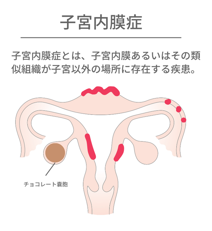 子宮内膜症とは、子宮内膜あるいはその類似組織が子宮以外の場所に存在する疾患