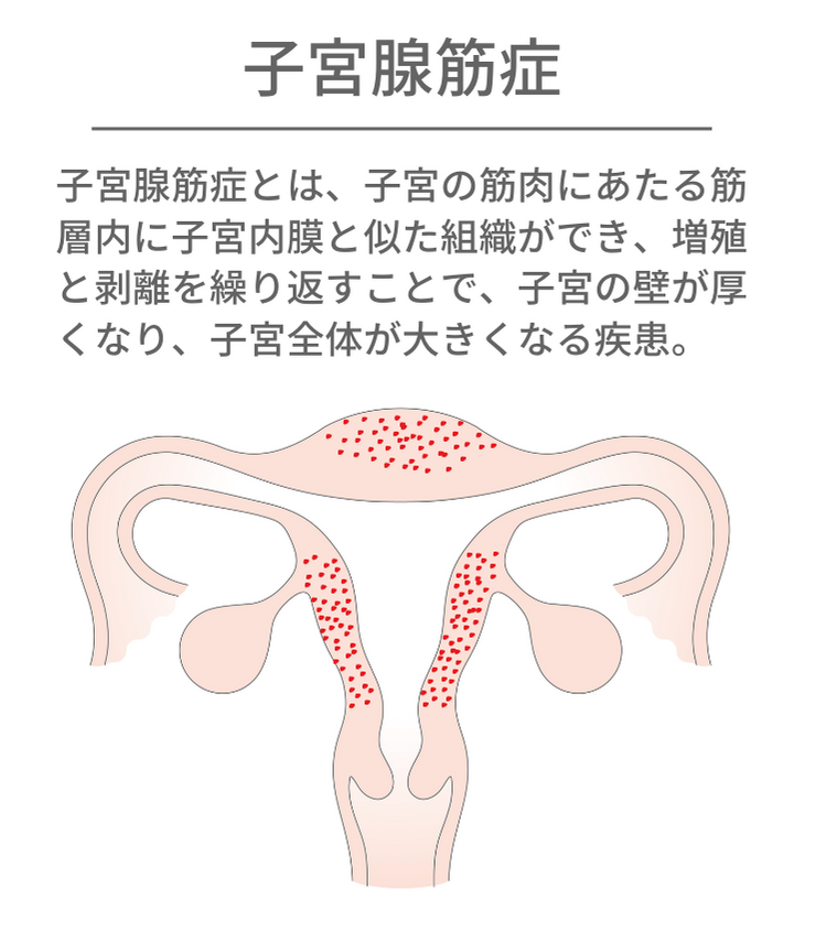 子宮腺筋症とは、子宮の筋肉にあたる筋層内に子宮内膜と似た組織ができ、増殖と剥離を繰り返すことで、子宮の壁が厚くなり、子宮全体が大きくなる疾患