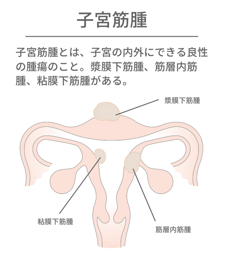 子宮筋腫とは、子宮の内外にできる良性の腫瘍です。