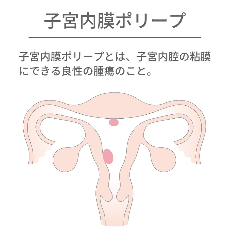 子宮内膜ポリープとは、子宮内腔の粘膜にできる良性の腫瘍です。