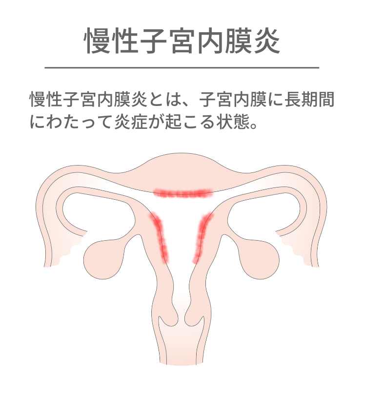 子宮内膜炎とは、子宮内膜に長期間にわたって炎症が起こる状態