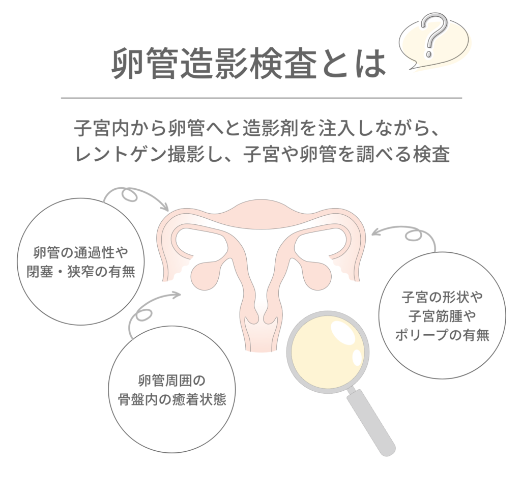 卵管造影検査についての説明図