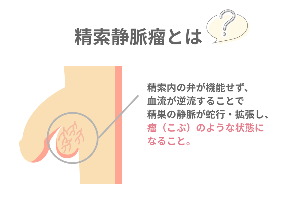 精索静脈瘤の図解