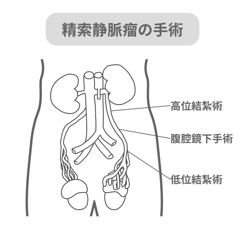 精索静脈瘤の手術についての図解