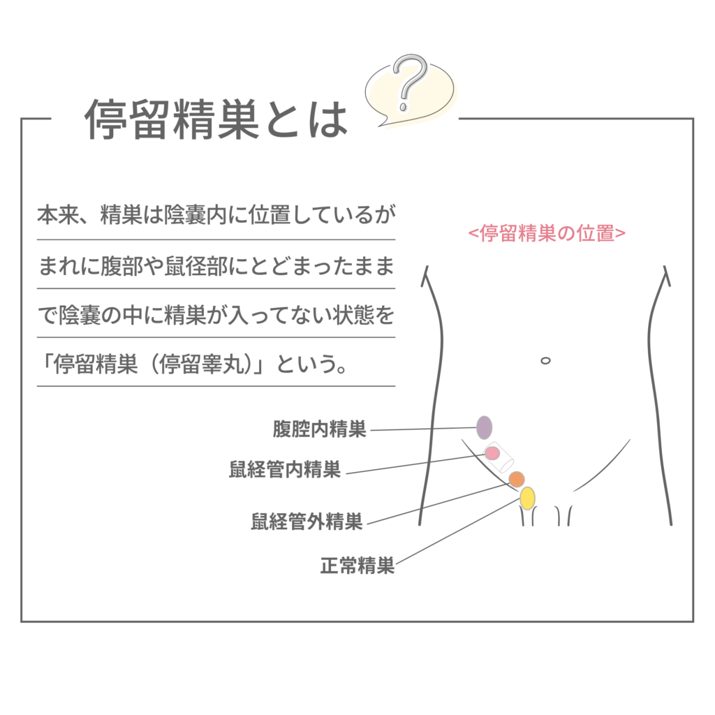 停留精巣の図解