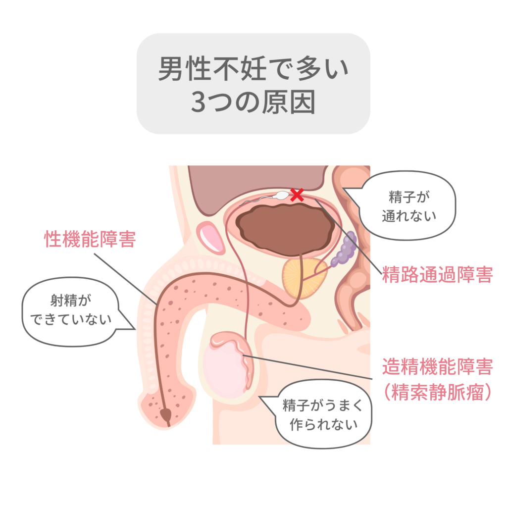 男性不妊で多い3つの原因