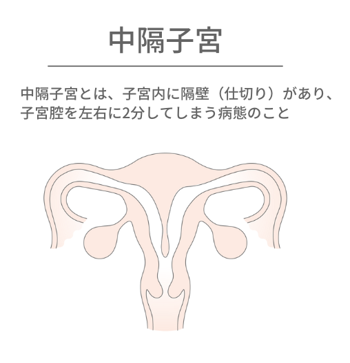 中隔子宮の説明