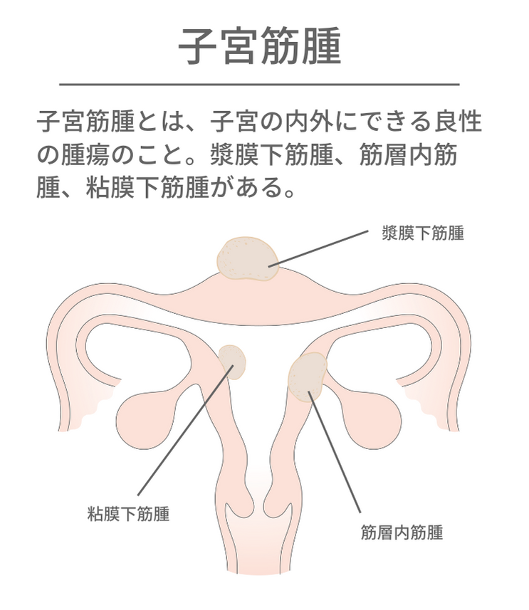 子宮筋腫の図解