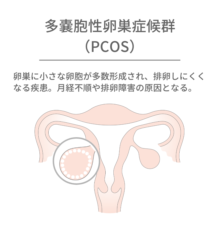 多嚢胞性卵巣症候群の図解