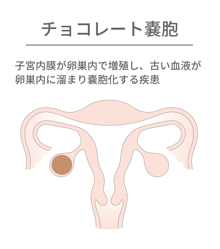 チョコレート嚢胞の図解