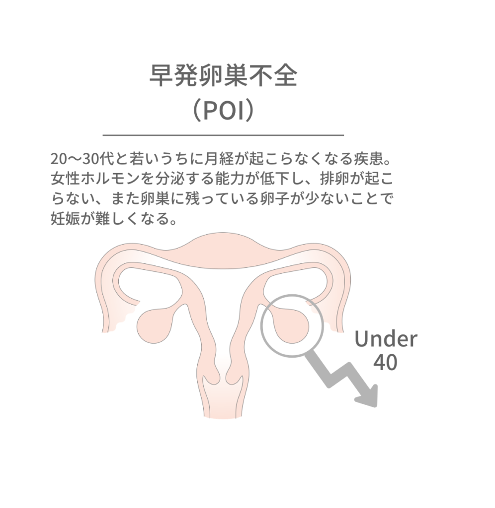 早発卵巣不全の図解