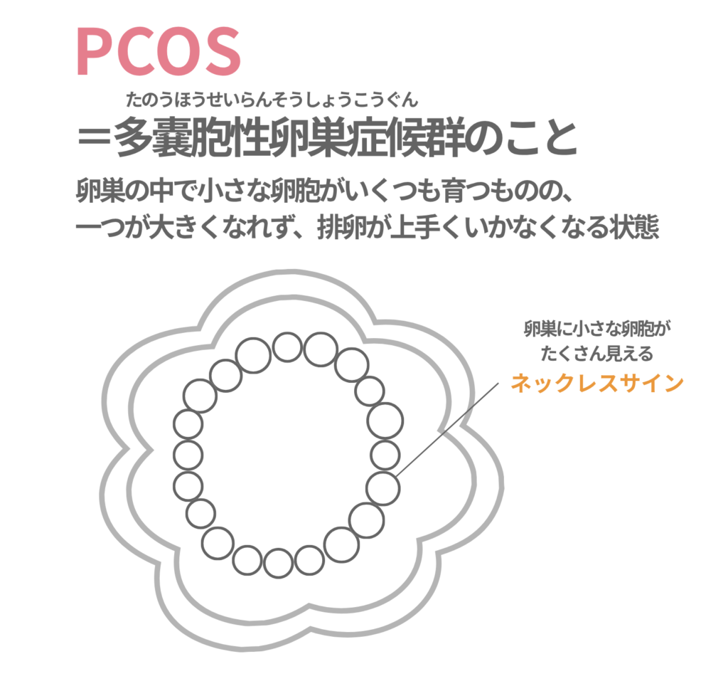 PCOS（多嚢胞性卵巣症候群/たのうほうせいらんそうしょうこうぐん）とは？