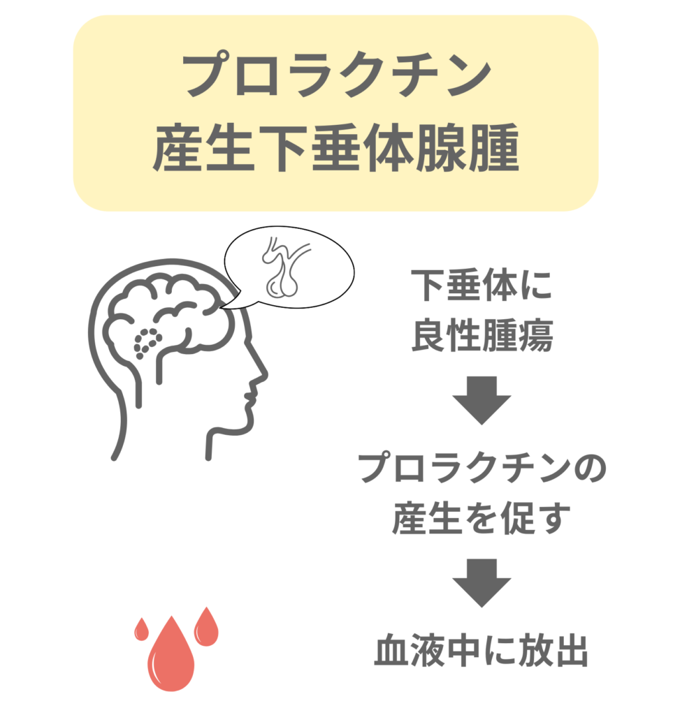 プロラクチン産生下垂体腺腫の図解