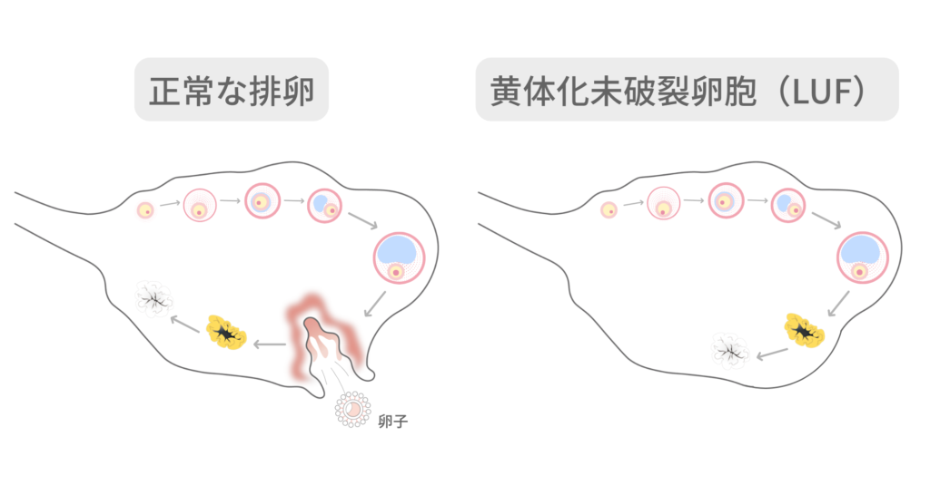正常な排卵と黄体化未破裂卵胞(LUF)の違いを図解